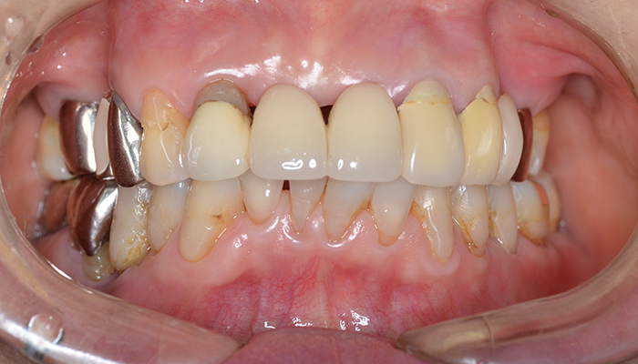 歯周病症例 治療前