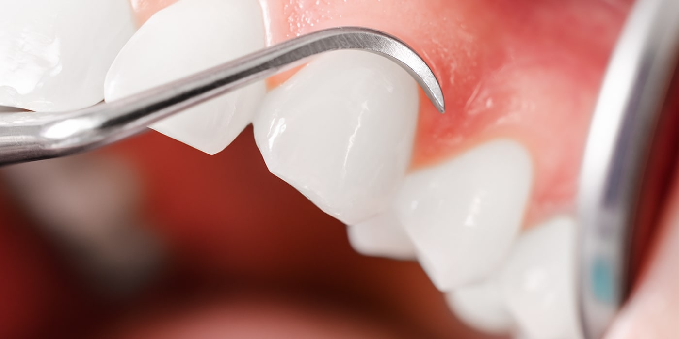 歯周病除菌治療（FMD）