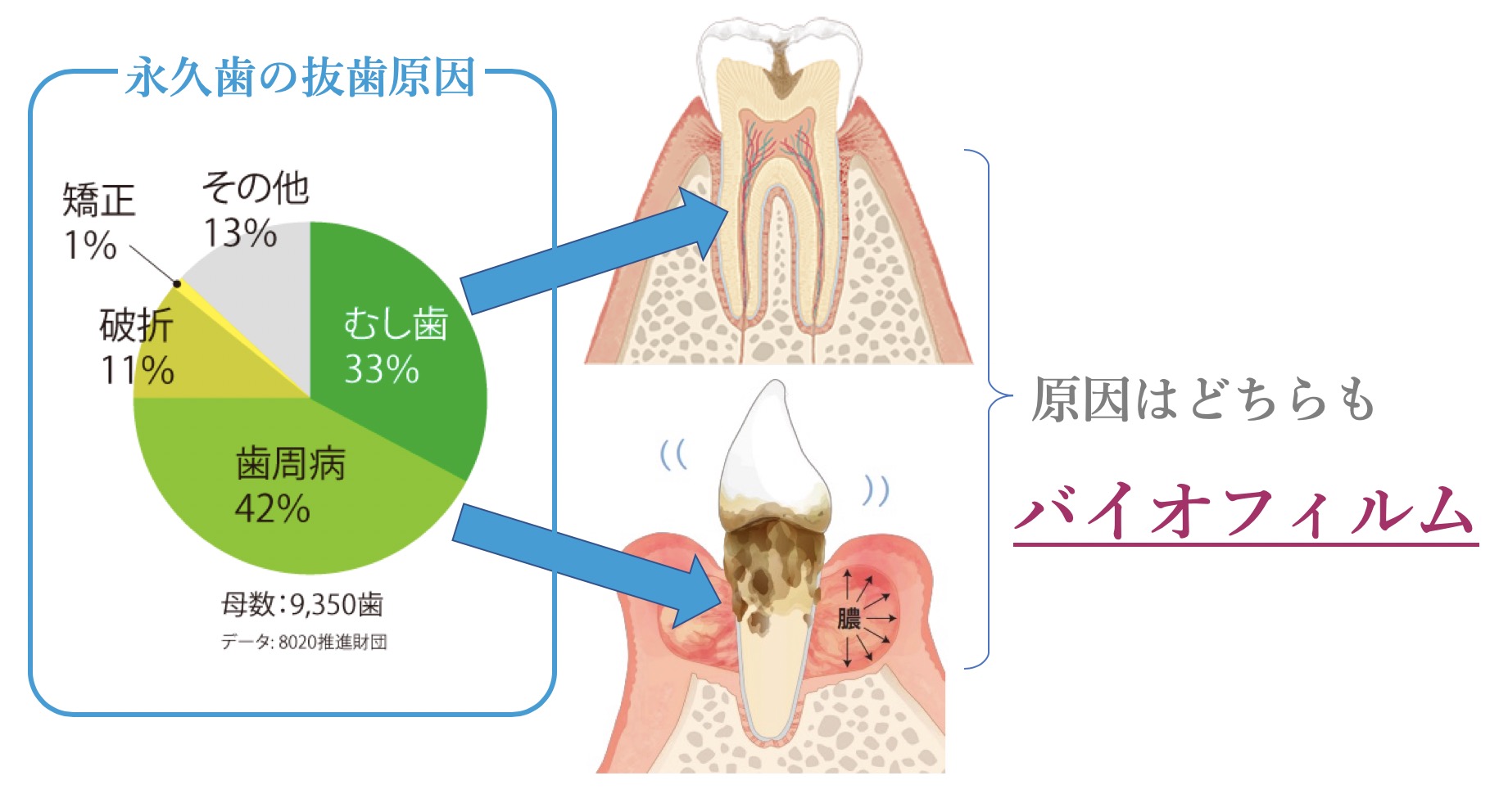 虫歯や歯周病の原因とは？