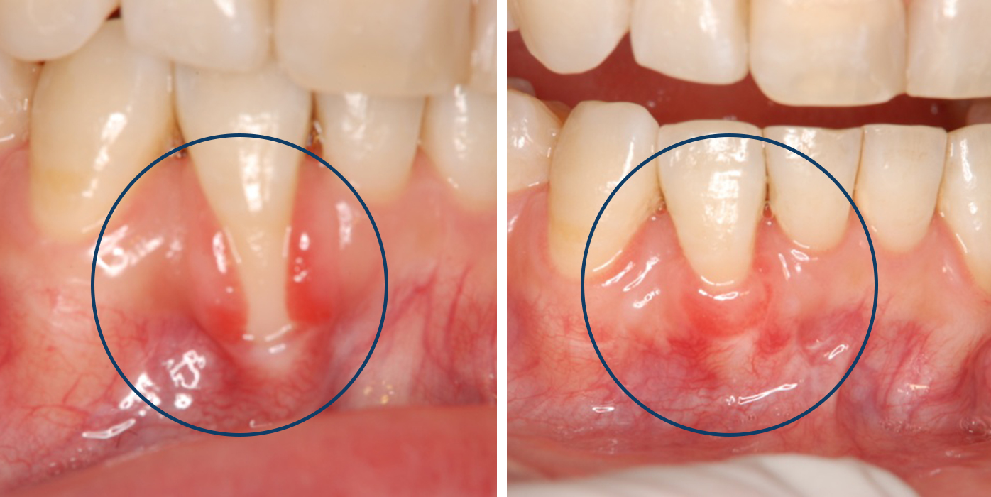 歯肉退縮の治療法とは？